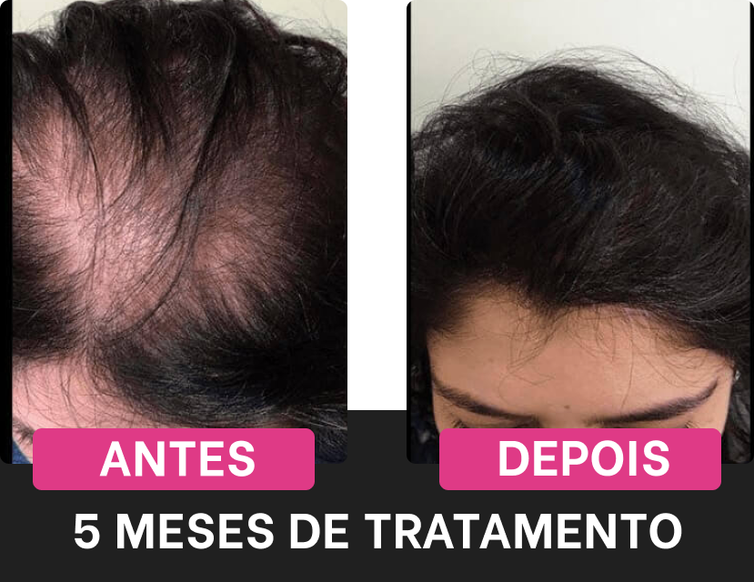 Efeitos positivos do tratamento Harmony Hair após 5 meses de uso regular, focando na área superior da cabeça.