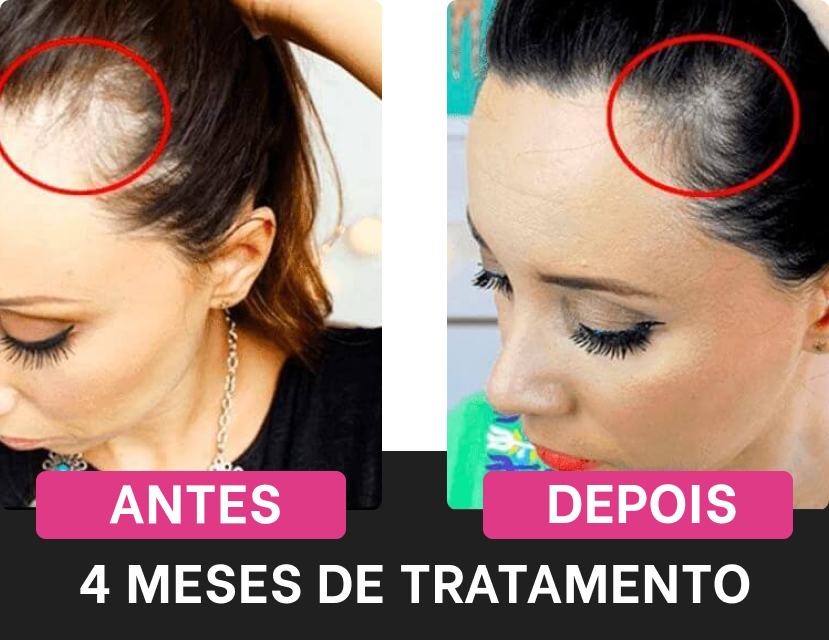 Efeitos positivos do tratamento Harmony Hair após 4 meses de uso regular, focando nas áreas laterais da cabeça.