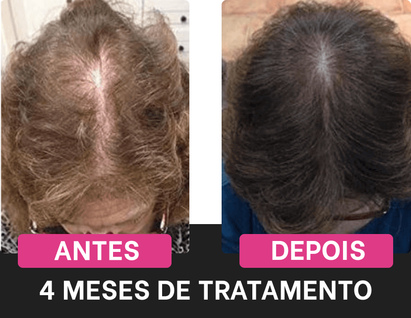 Efeitos positivos do tratamento Harmony Hair após 4 meses de uso regular.