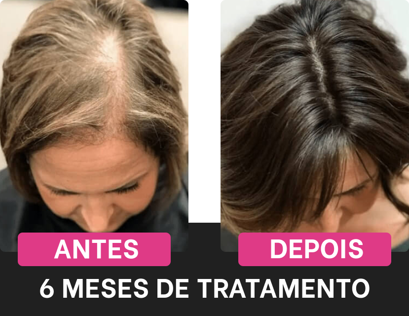 Efeitos positivos do tratamento Harmony Hair após 6 meses de uso regular, focando na área superior do couro cabeludo.