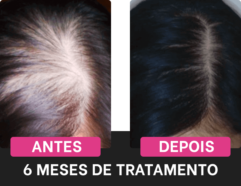 Efeitos positivos do tratamento Harmony Hair após 6 meses de uso regular, focando na área central do couro cabeludo.