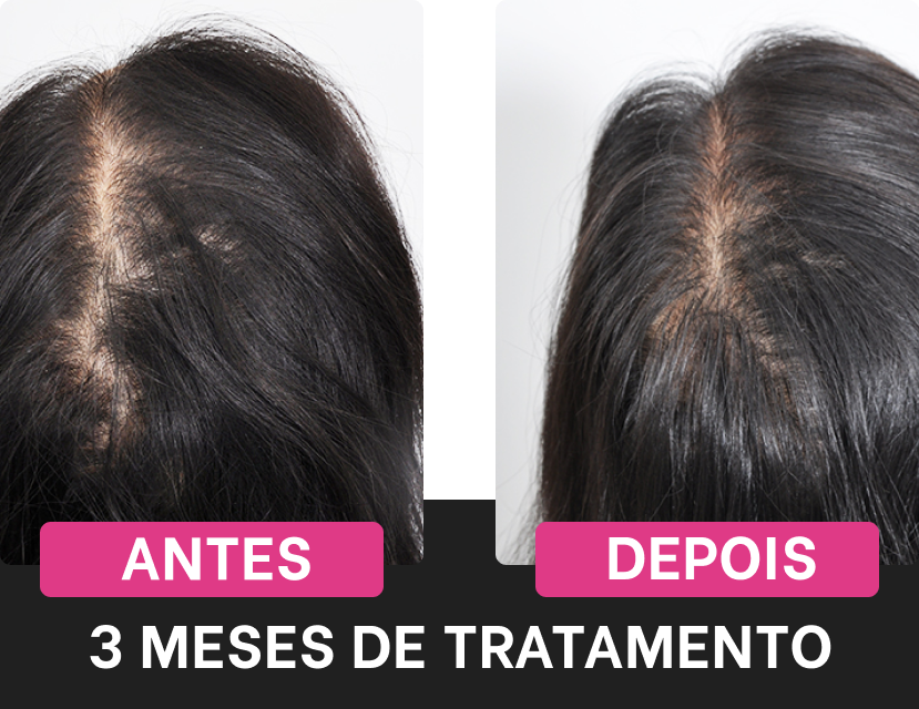 Resultados do tratamento com Harmony Hair após 3 meses, mostrando antes e depois da utilização.