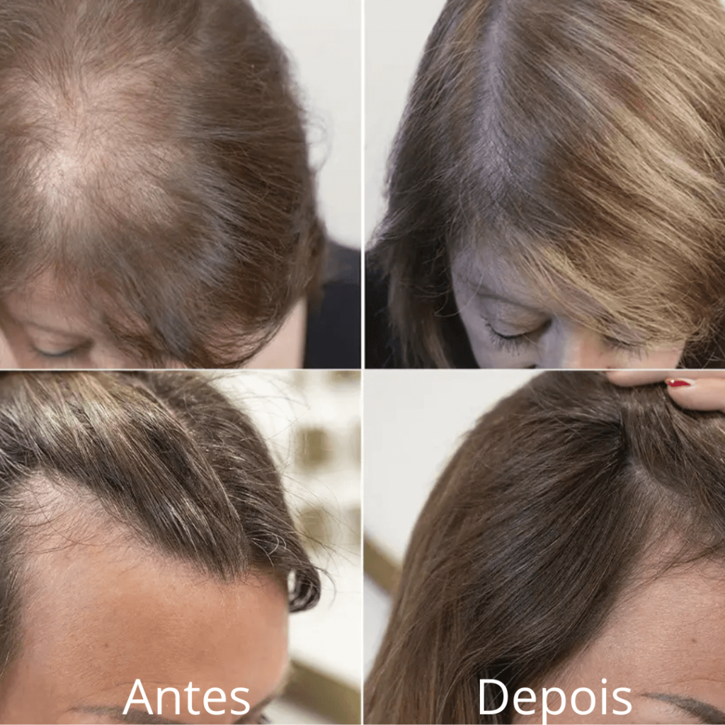 Resultados do tratamento capilar com Harmony Hair mostrando crescimento e fortalecimento do cabelo